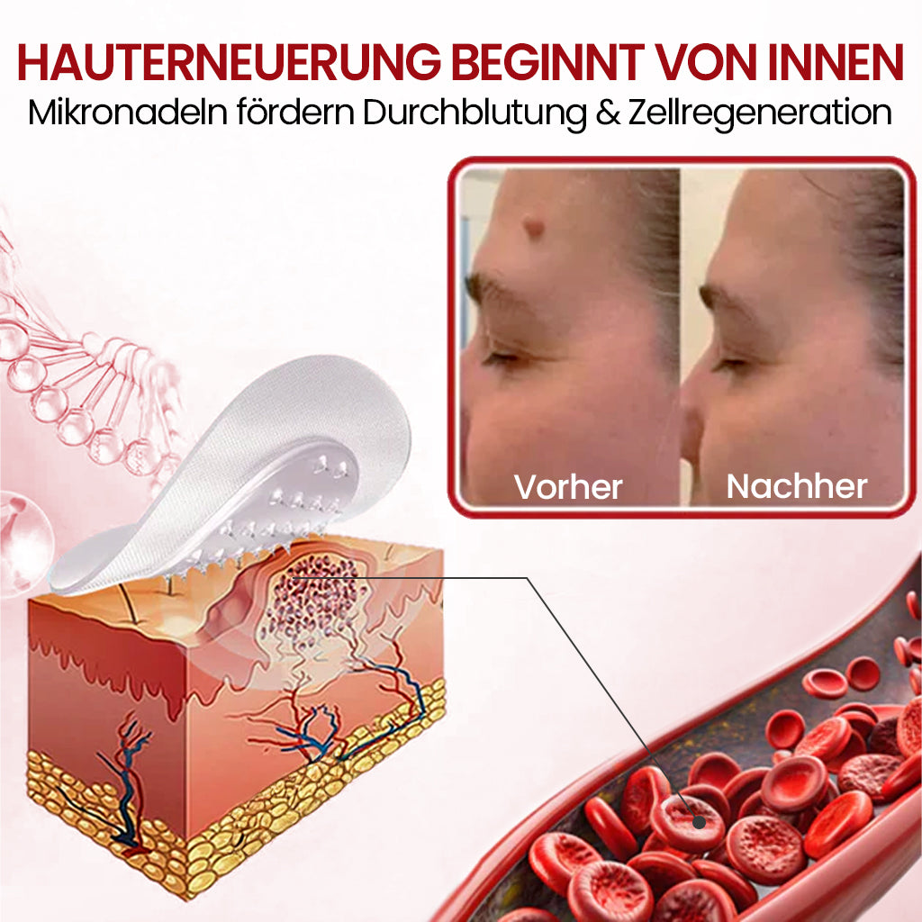 🔥 Cvreoz® Mikronadel-Pflaster – 2025 optimierte Formel gegen Hautanhängsel & Warzen