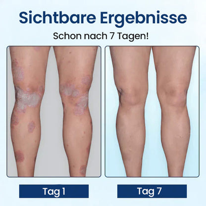 🌿CVREOZ® SootheGlow Anti-Schuppen & Juckreiz Creme