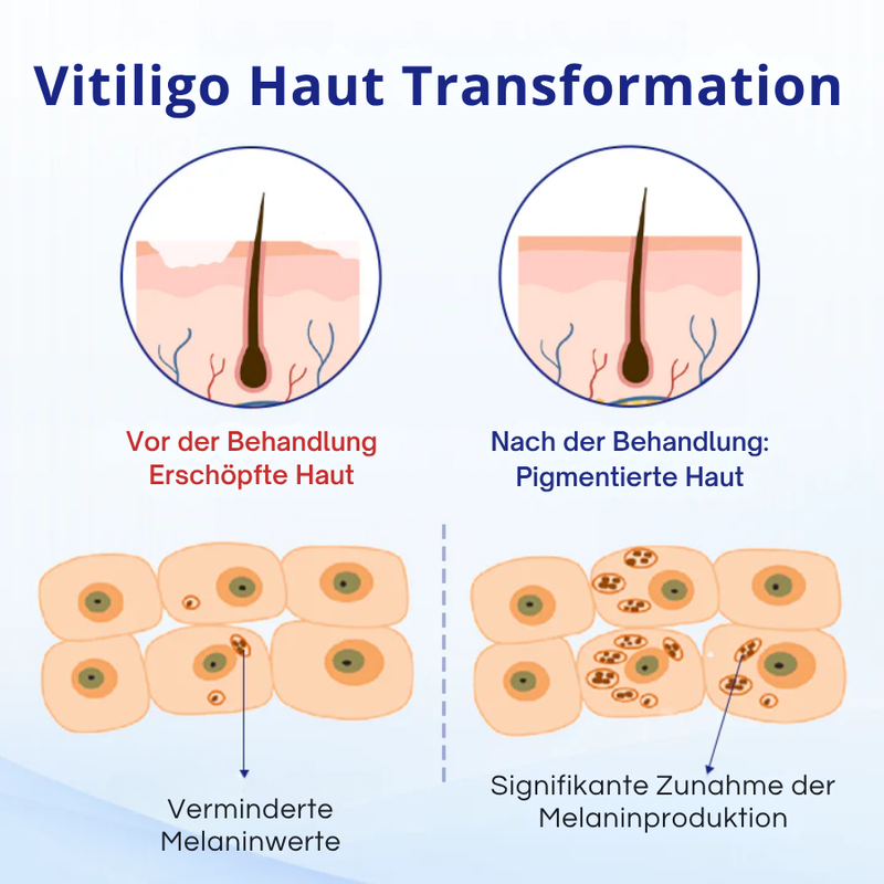 Cvreoz® Spray gegen Vitiligo — Dermatologisch getestet, pflanzlich & steroidfrei