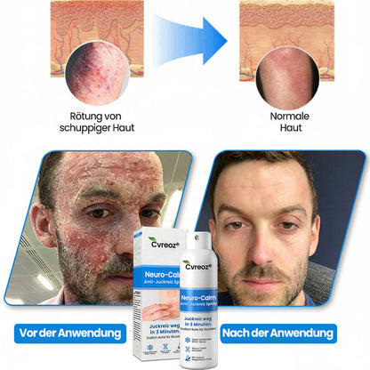 ✅Cvreoz® Neuro-Calm Anti-Juckreiz Akut-Spray – Stoppt Juckreiz sofort (Offer)