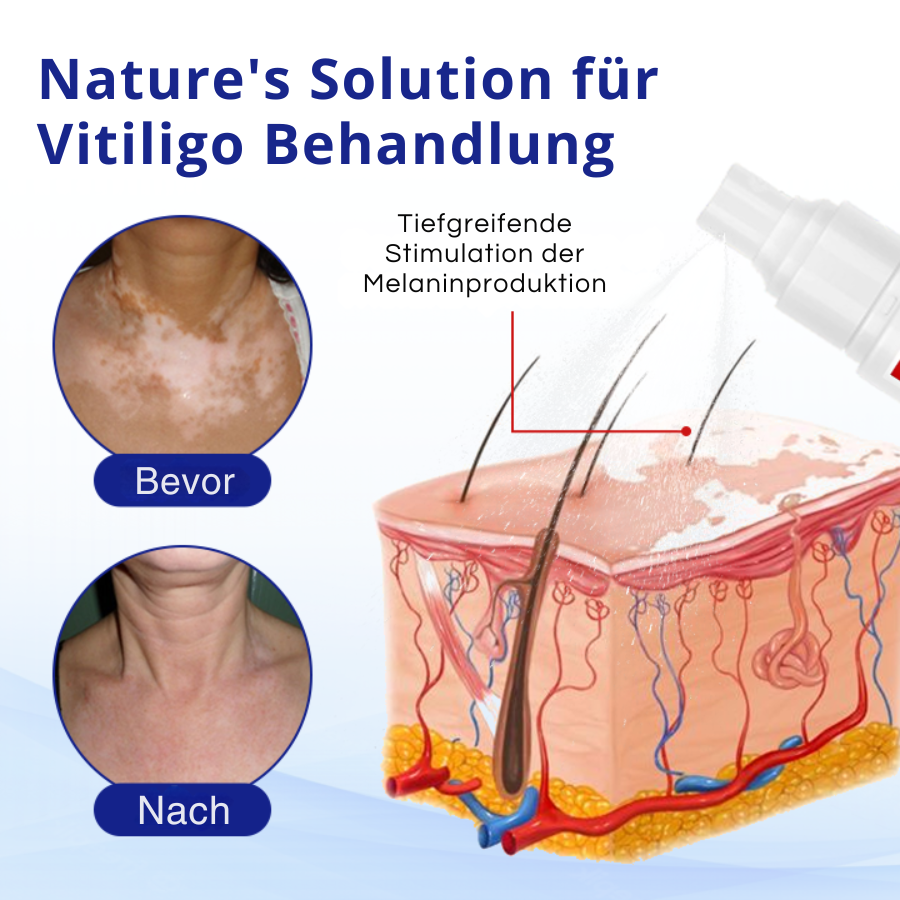 Cvreoz® Spray gegen Vitiligo — Dermatologisch getestet, pflanzlich & steroidfrei