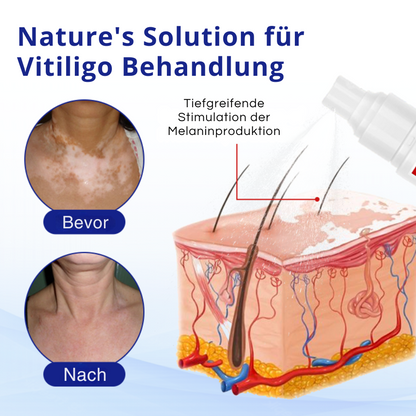 Cvreoz® Spray gegen Vitiligo — Dermatologisch getestet, pflanzlich & steroidfrei