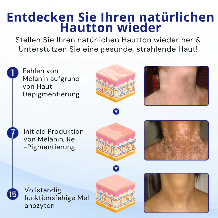 Cvreoz® Spray gegen Vitiligo — Dermatologisch getestet, pflanzlich & steroidfrei