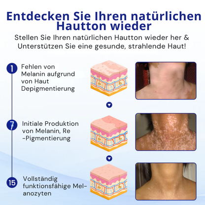 Cvreoz® Spray gegen Vitiligo — Dermatologisch getestet, pflanzlich & steroidfrei